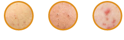 Whiteheads/Blackheads/Redheads